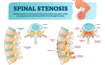 Lumbar Spinal Stenosis: How Physical Therapy Can Help You Walk Farther and Feel Better